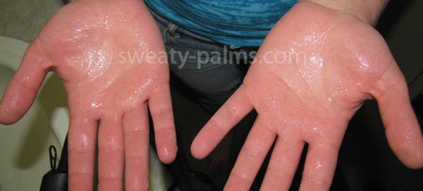 sweaty palms ssb interview medical