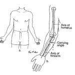 excessive carrying angle of the elbow