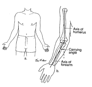 excessive carrying angle of the elbow