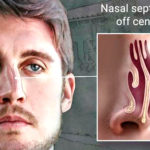 deviated nasal septum ssb interview