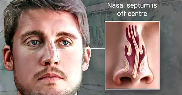 deviated nasal septum ssb interview