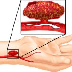 Upper Limb Salvage Surgery