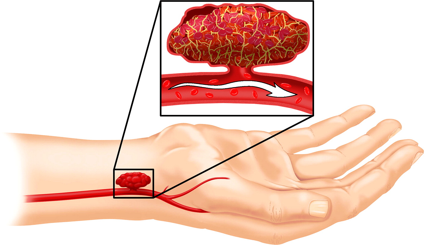 Upper Limb Salvage Surgery